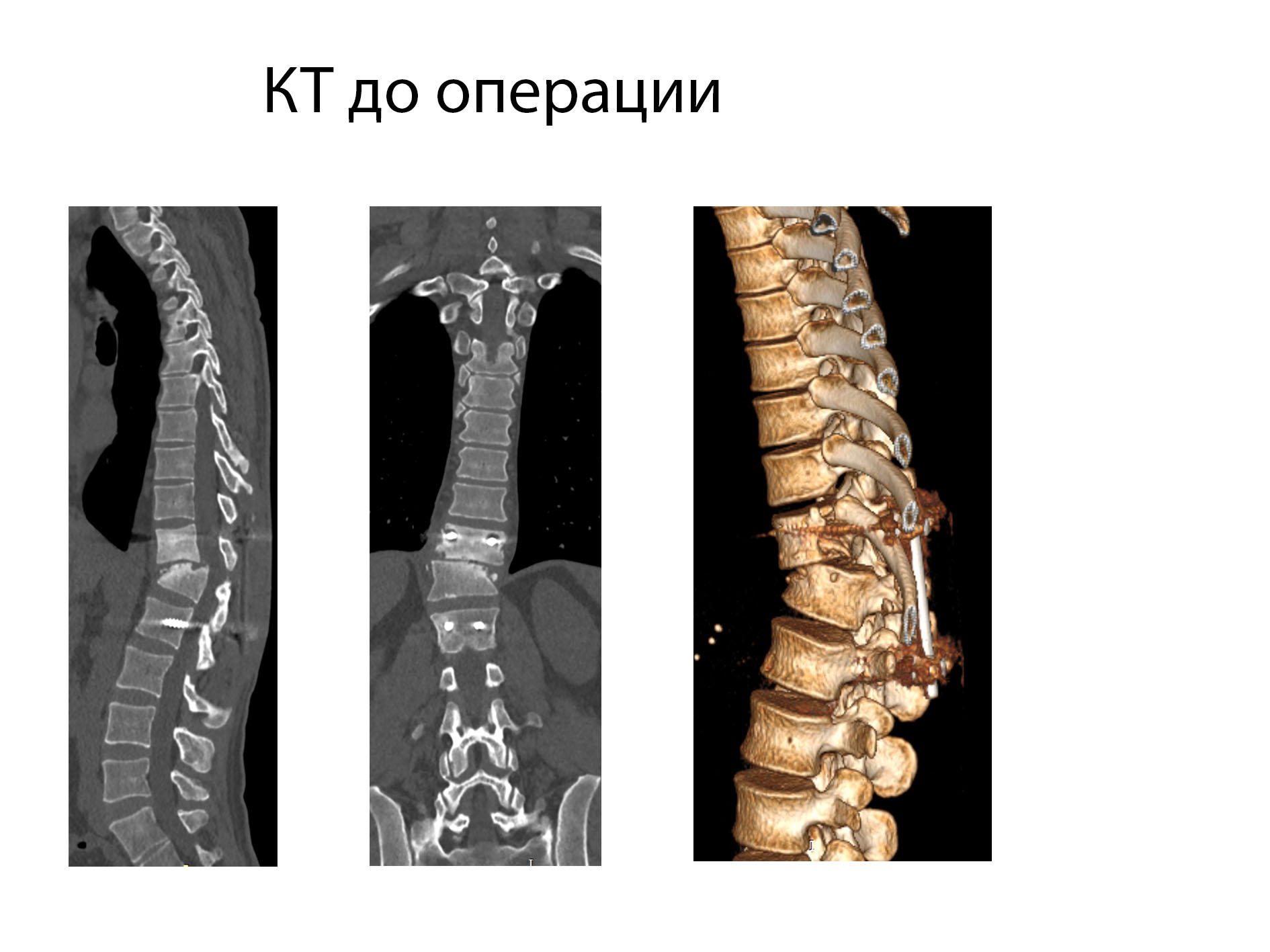 Очередная ревизионная операция в Центре хирургии позвоночника