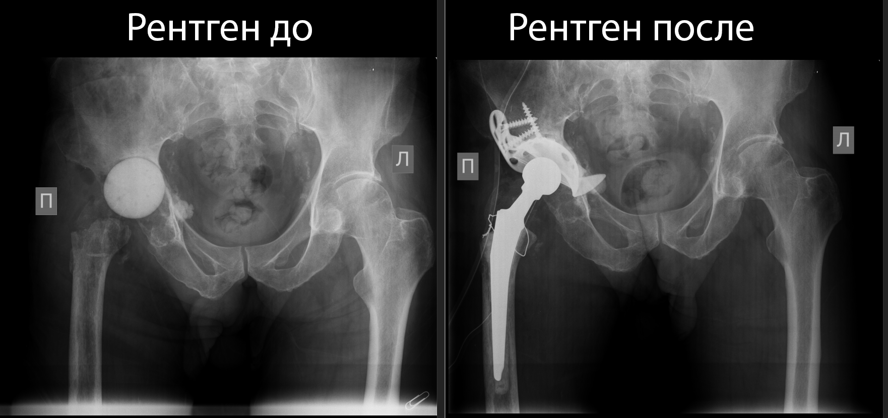 Врачи ФГБУ «СПб НИИФ» выполнили ревизионное эндопротезирование правого тазобедренного сустава