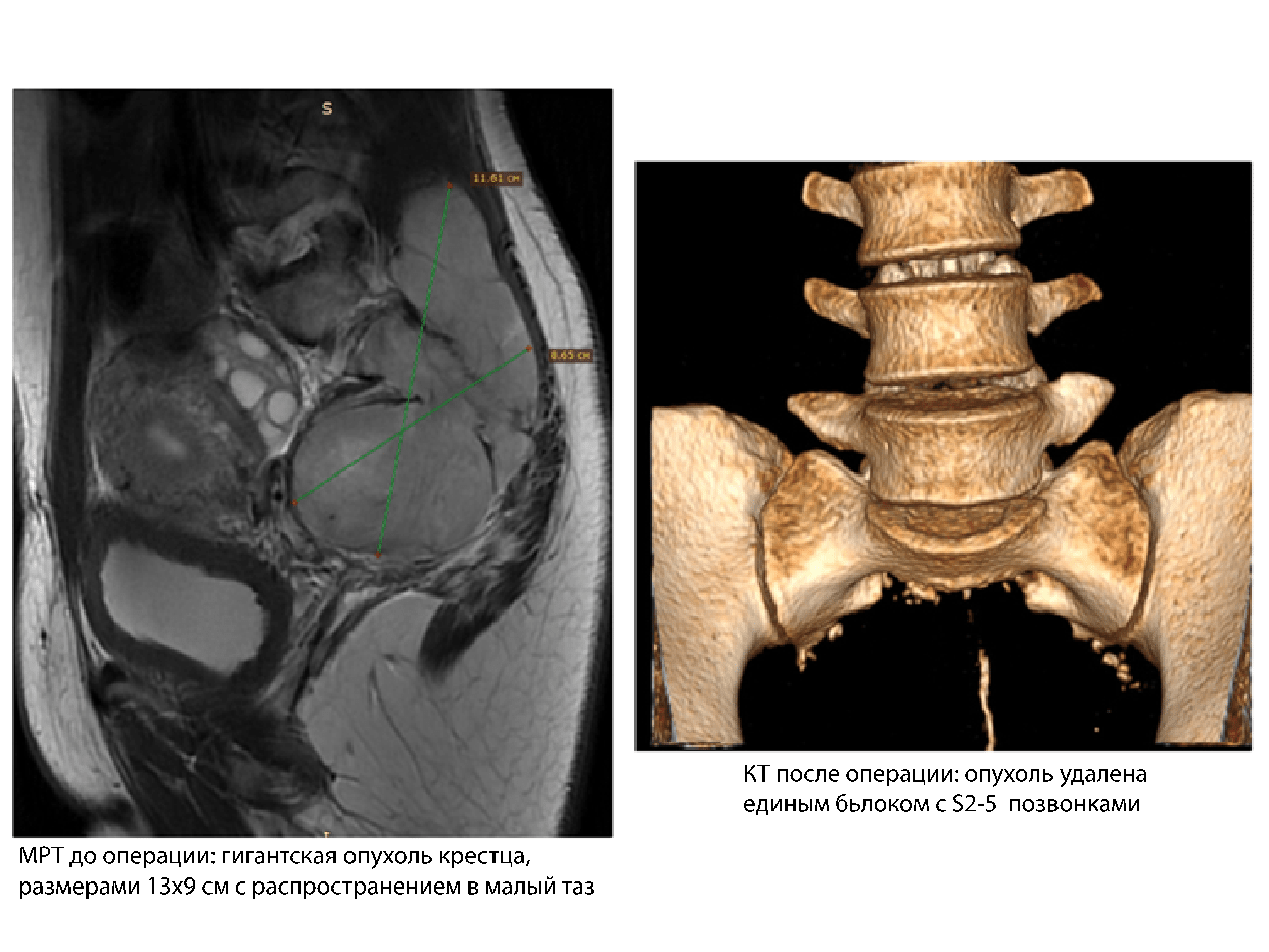Врачи научно-клинического центра патологии позвоночника ФГБУ СПб НИИФ извлекли гигантскую опухоль крестца