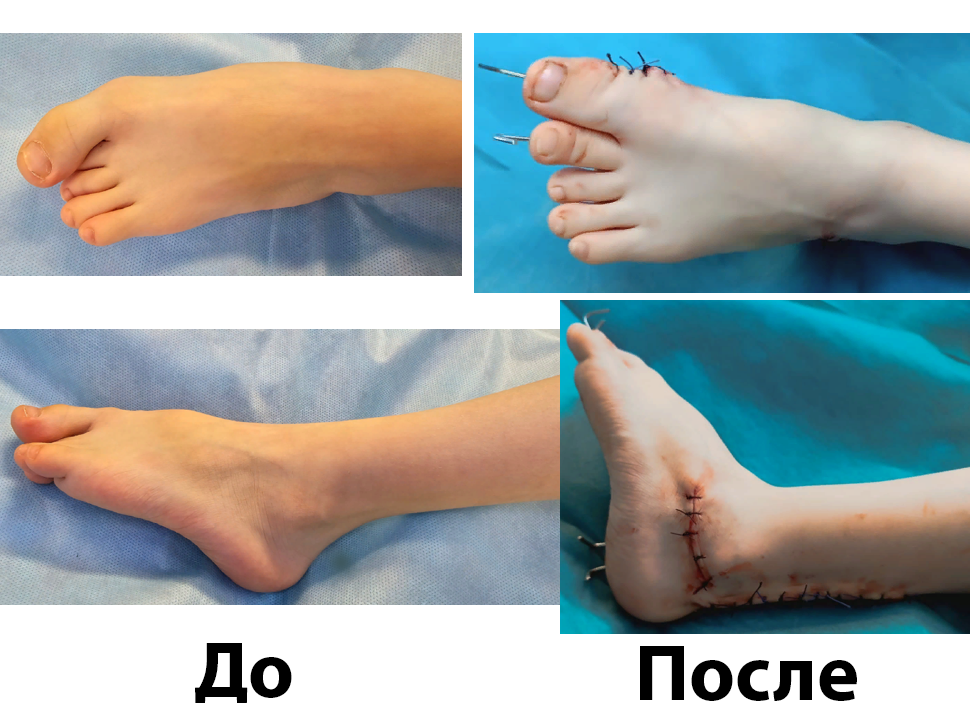 Помощь детям с патологиями нижних конечностей