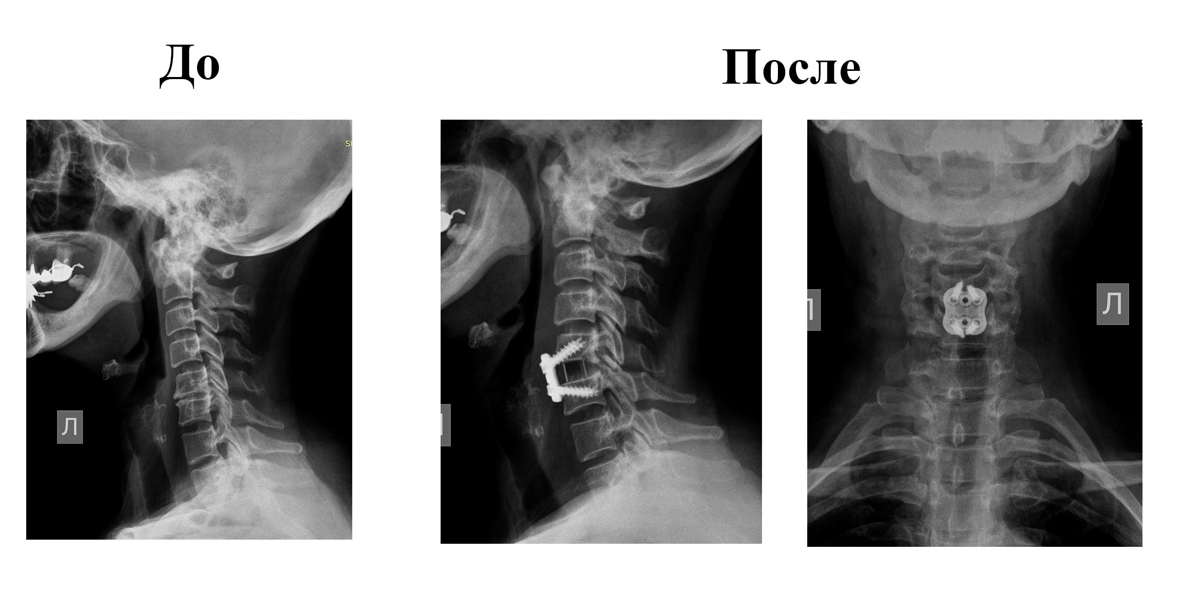 Реконструктивные операции на шейном отделе в Центре хирургии позвоночника