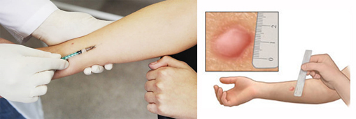 Иммунодиагностика туберкулеза